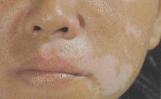 哪些原因会引发白癜风的发生