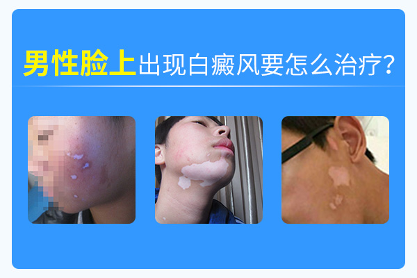面部出现白癜风如何去治疗?